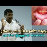 அடிக்கடி வாய்ப்புண் வர காரணம் இதுதான் | Healer baskar treatment on mouth ulcer