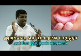 அடிக்கடி வாய்ப்புண் வர காரணம் இதுதான் | Healer baskar treatment on mouth ulcer
