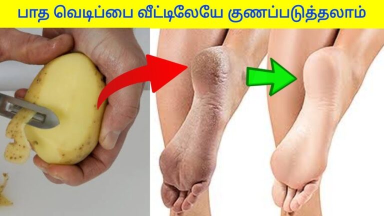 பாத வெடிப்பு குணமாக வீட்டு மருத்துவம் | Foot crack home remedy